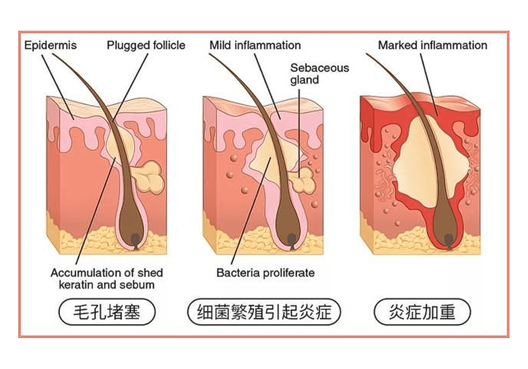 正确祛痘方式 干净的脸才是美