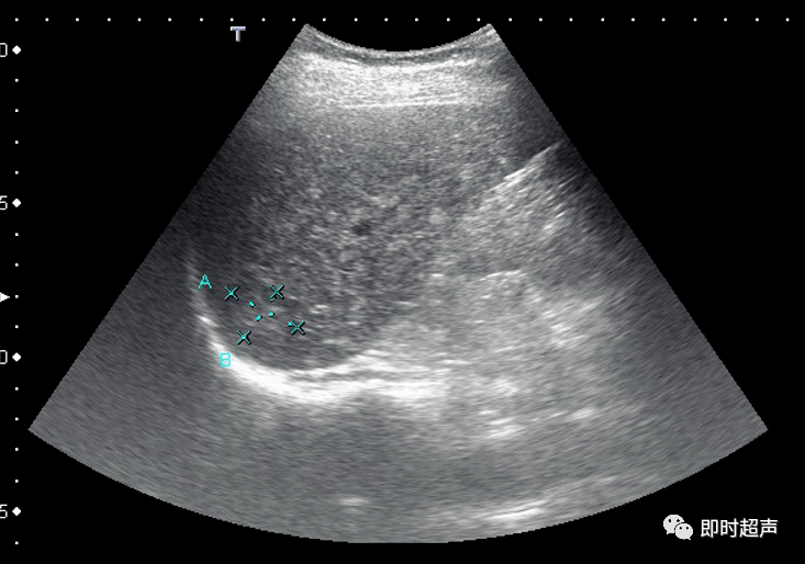 肝右叶超声测量图片图片