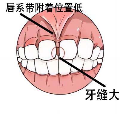 唇系带手术切口图片图片