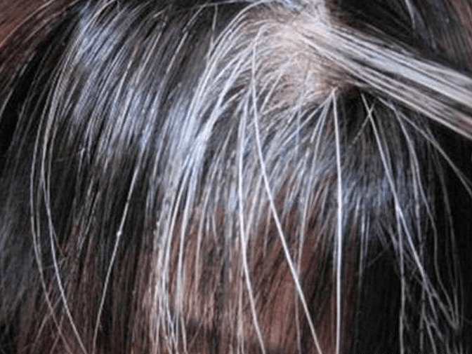 育发乌丝:长白发到底能拔吗?_头发_毛囊_黑色素