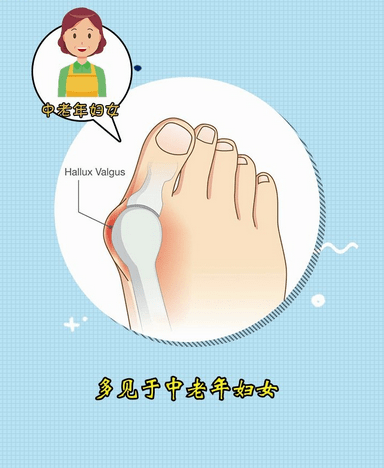 牛江红解说，拇外翻一定会得拇囊炎吗?_患者_程度_治疗