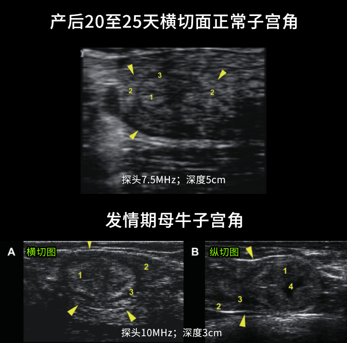 子宫内膜增厚b超图片