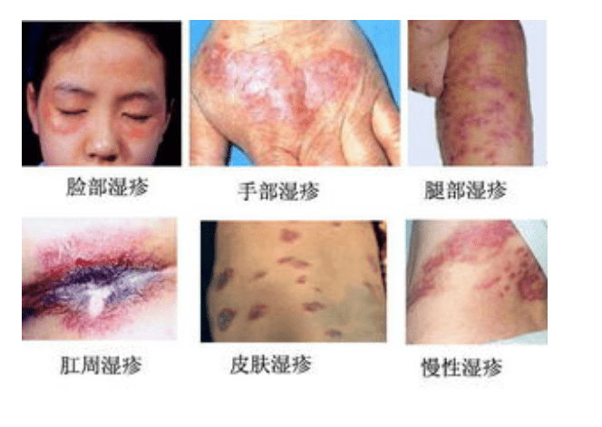皮肤癌和湿疹图片对比图片