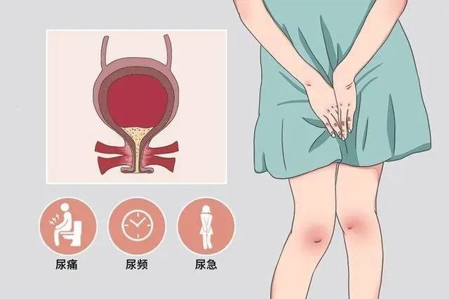 女性尿频尿急 方法图片