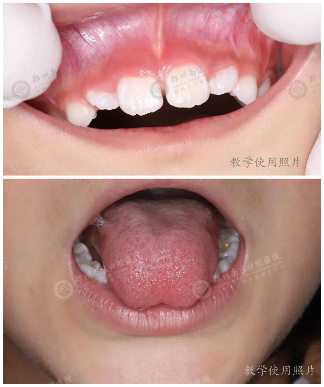孩子门牙缝隙大,说话发音不清,可能是唇,舌系带惹的祸