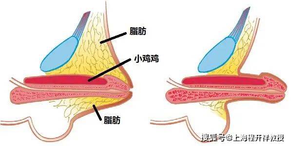 小丁丁根部图片