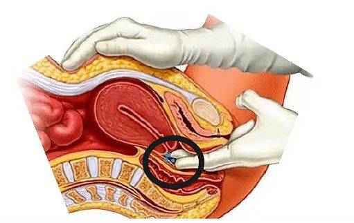 如果在进行肛门指检的时候手伸进到肛门里边会发现有肿块而且比较硬