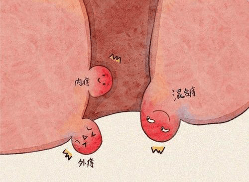 痔疮怎么引起的啊 来自搜狐网