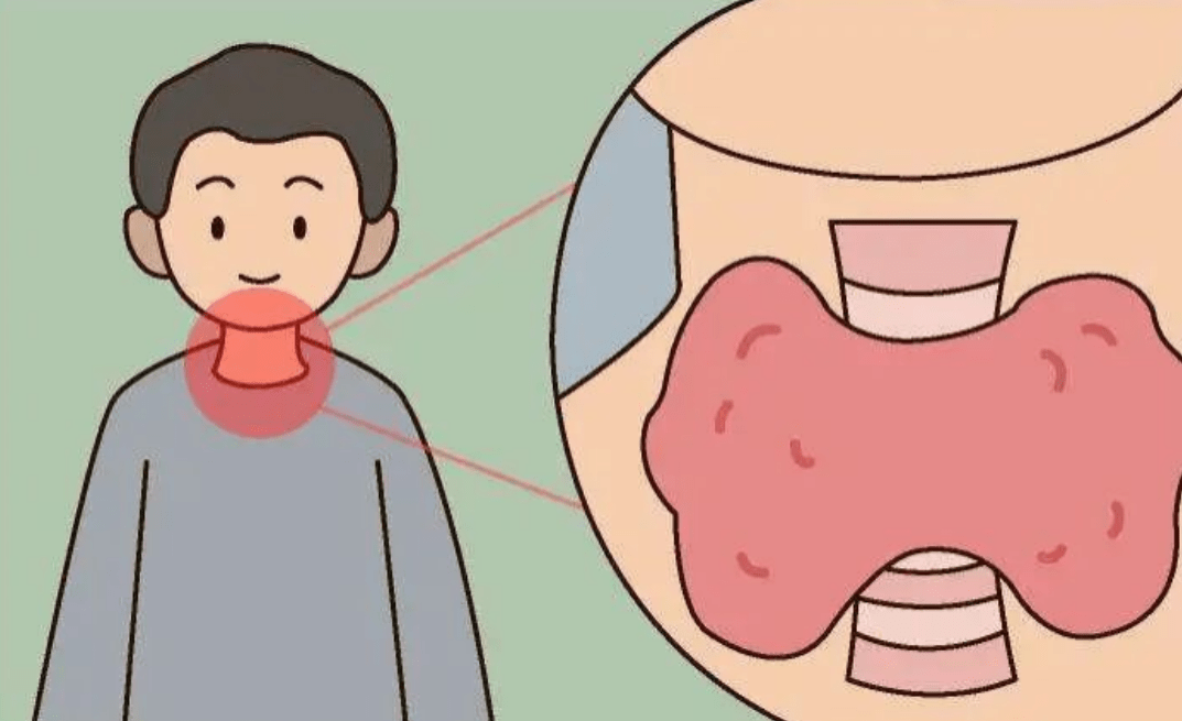 代文新主任详细描述:儿童甲状腺癌的早期症状及预防措施_进行_颈部