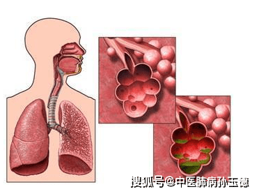 北京崇文門中醫醫院呼吸科專家孫玉德:這10個肺氣腫誤區,一不小心就會