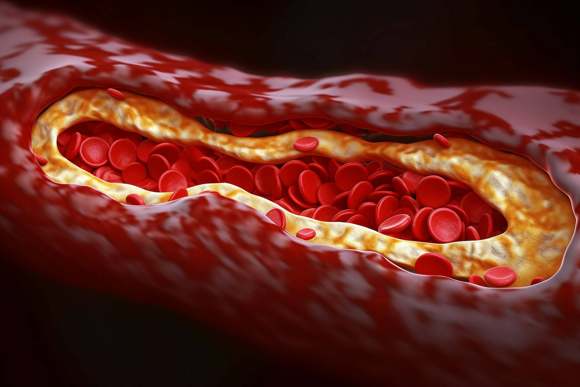 冬季防护深静脉血栓,从小细节做起_运动_风险_饮食