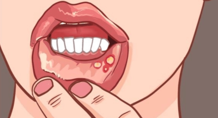 舌头上溃疡怎么治图片