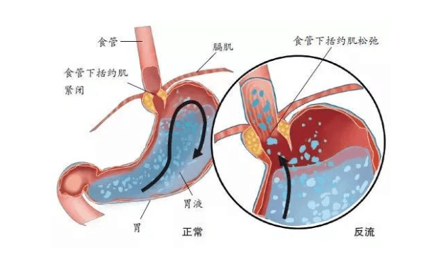 希洛施泮托拉唑鈉腸溶片:胃酸逆流而上,胃食管反流