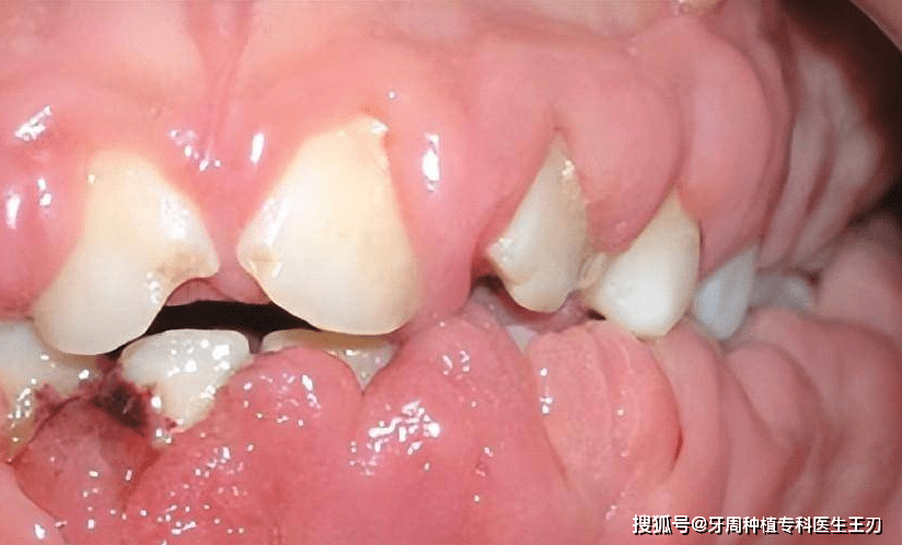 急性单核细胞白血病患者的牙龈增生原因五:遗传性牙龈纤维瘤病 (hgf)