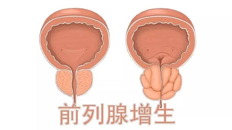 前列腺增生的症状有哪些?杭州新城医院男科徐荣清医生解答