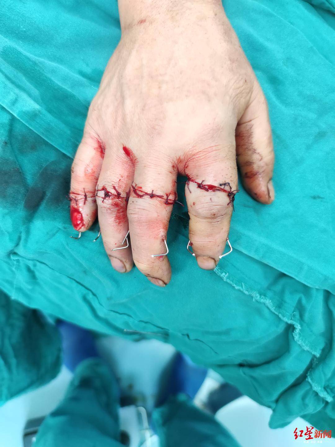 4指被切断医生用0 1毫米线缝合血管历时10小时完成断指再植 手指