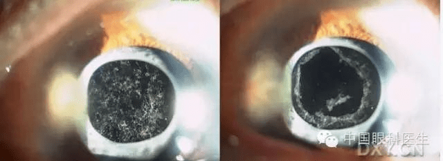 爱眼日专题丨白内障的常见问题_晶状体