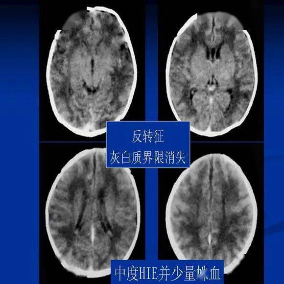 新生儿缺氧缺血性脑病的ct诊断