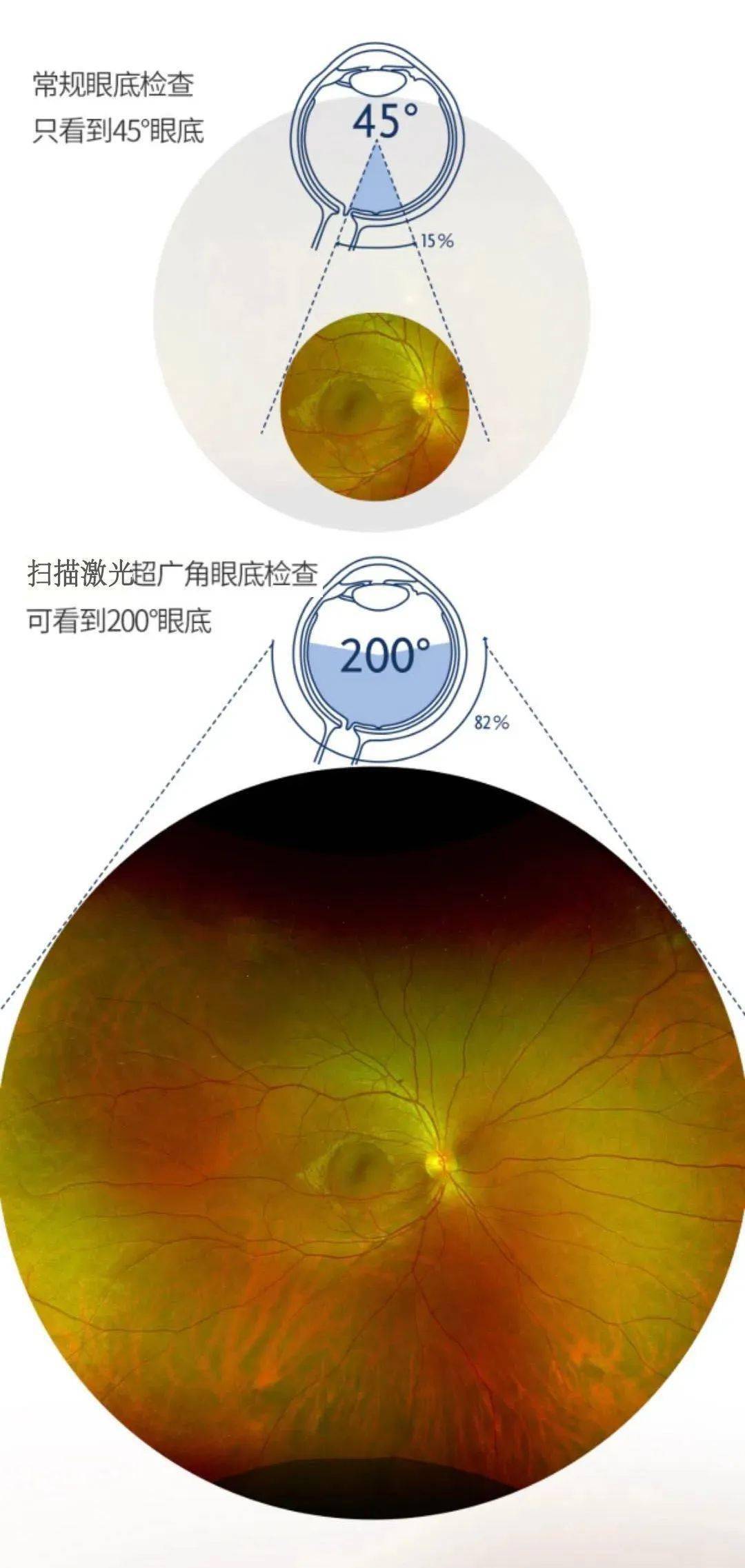 容易漏诊和误诊,而扫描激光眼底检查则可呈现远至周边部的眼底情况