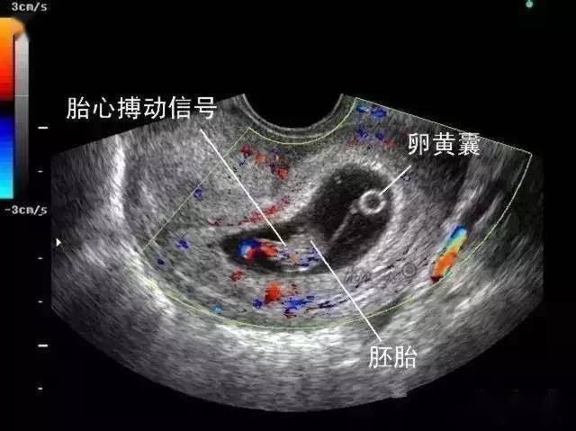 不同类型流产的超声表现_胚胎