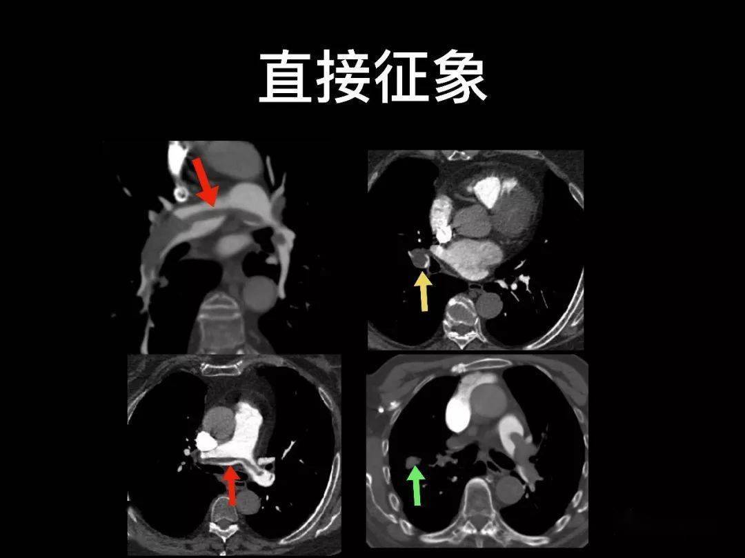 肺栓塞的影像诊断与鉴别诊断