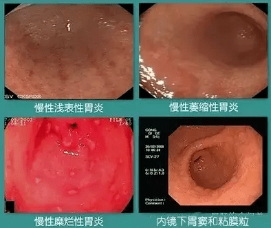 胃总是隐隐作痛到底是什么毛病不外乎是以下五四种情况