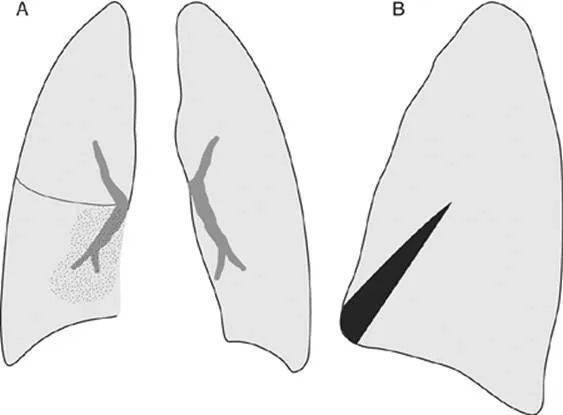 肺门不张图片