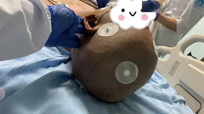 24岁小伙突发脑干出血,濒死时刻机器人手术拯救生命!
