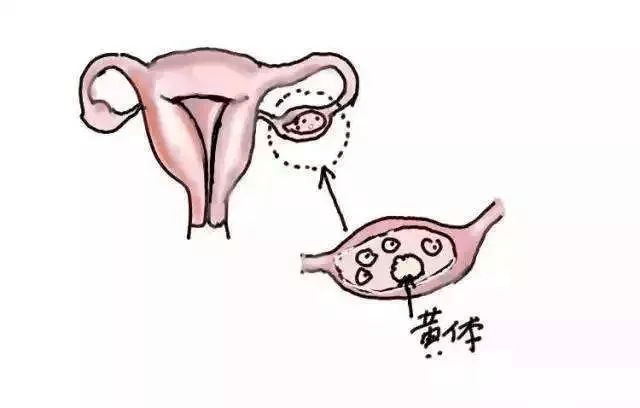 卵巢黃體破裂是怎麼回事?