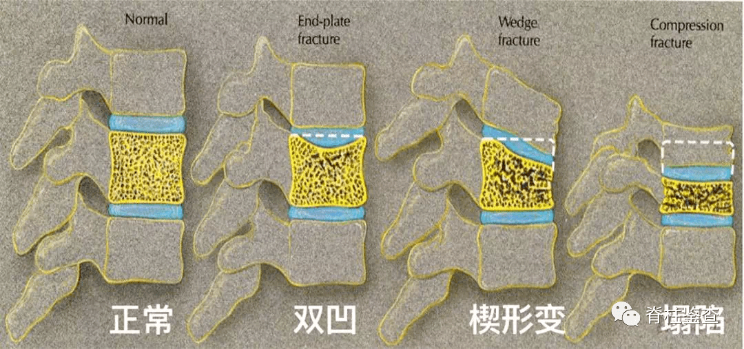 pkp手术进针点图解图片