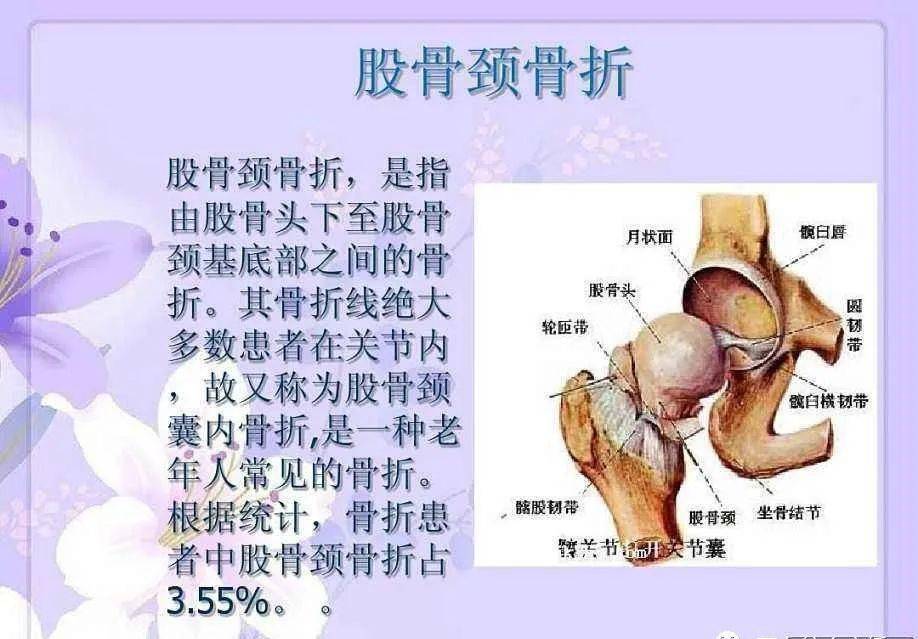 &人生最后一次骨折!_股骨颈