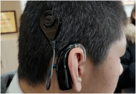 向命运的抗争者致敬仁品人工耳蜗植入中心真实案例盘点