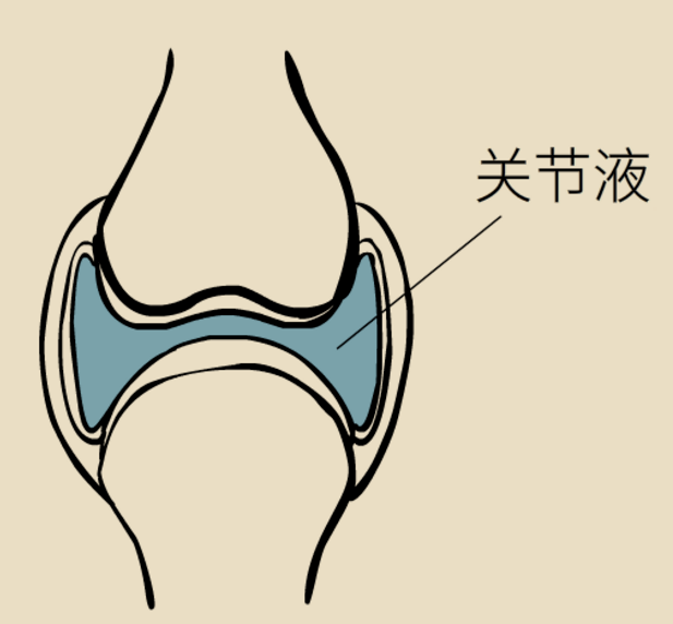 关节积液莫小瞧,及时治疗很重要