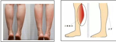 腓肠肌起点位于膝关节之上,通常在站立位或伸膝蹬足时收缩发力,很多
