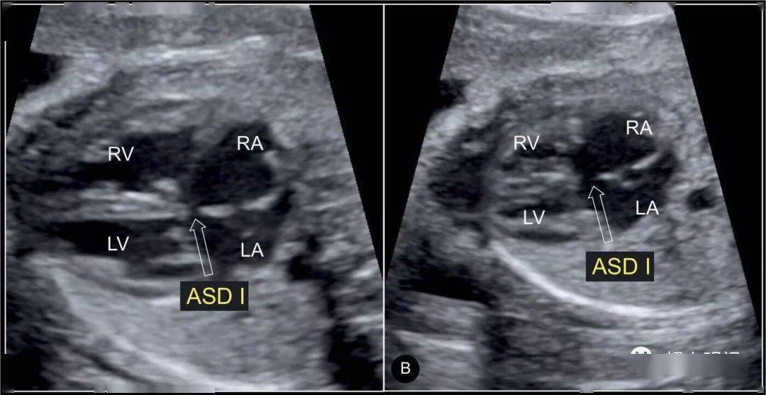 再谈胎儿心脏四腔观上要注意有没有一根胡须