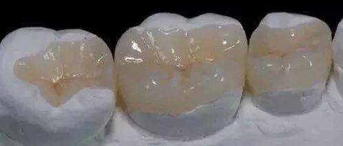 死髓牙嵌体图片
