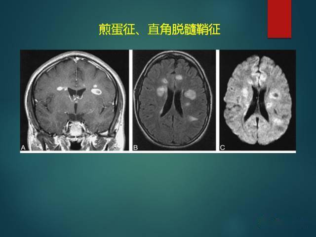 ms ) :中青年女性; 症狀發作與緩解交替出現;直角脫髓鞘徵;不同時期脫