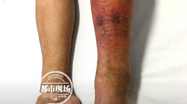 暴雨天,男子蹚水上班,结果"中毒"腿部溃烂_皮肤