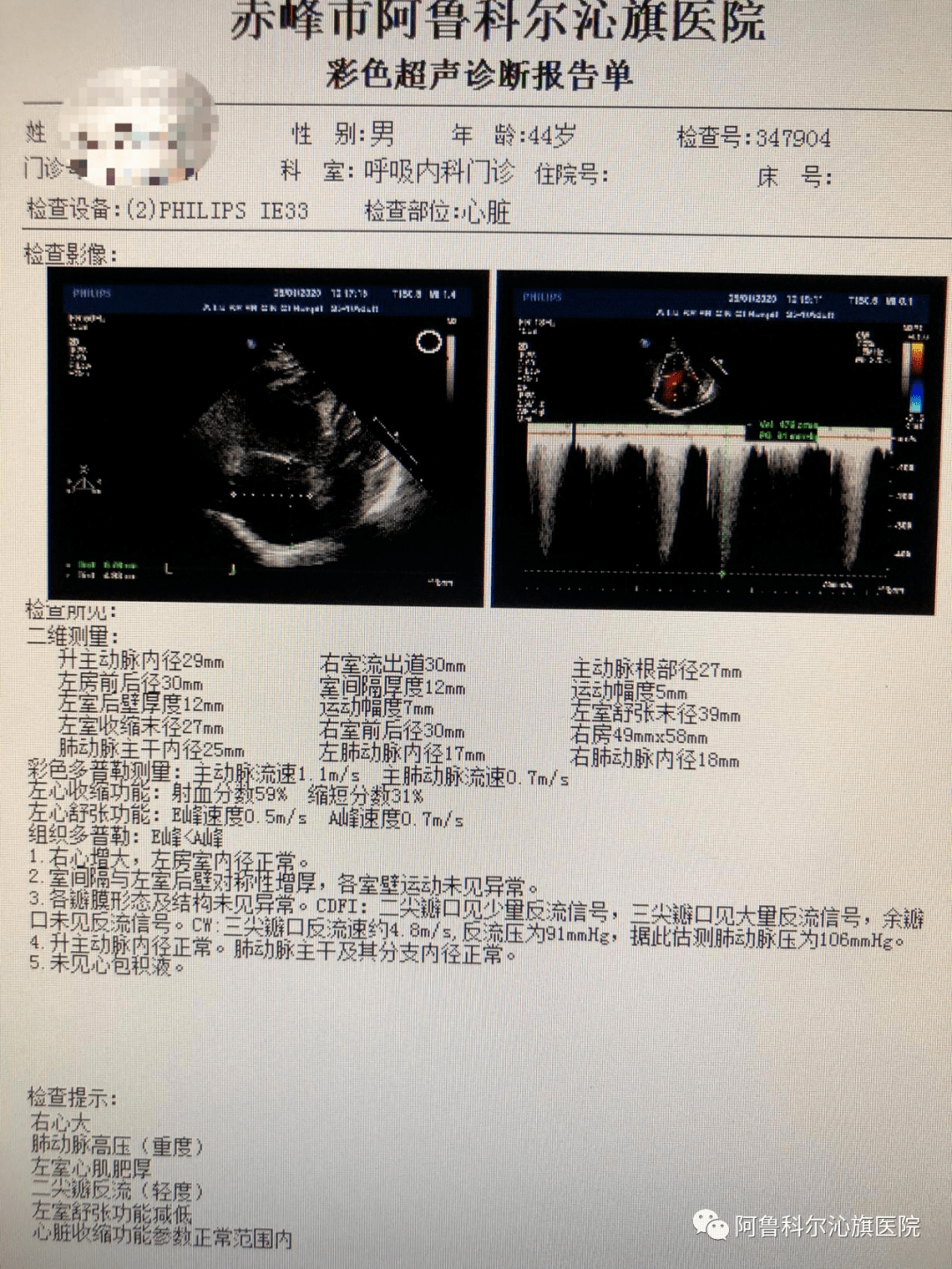 肺动脉交叉超声图片图片