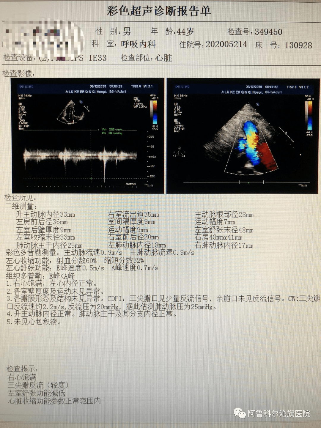 肺动脉交叉超声图片图片