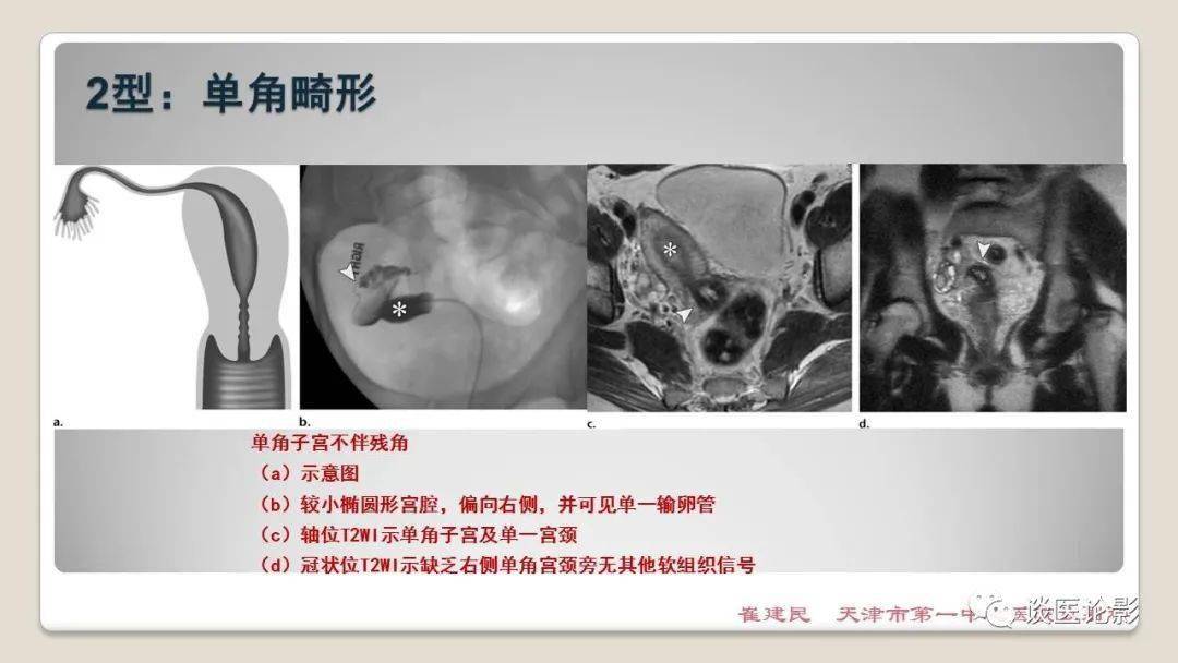 苗勒氏管畸形影像表现_子宫