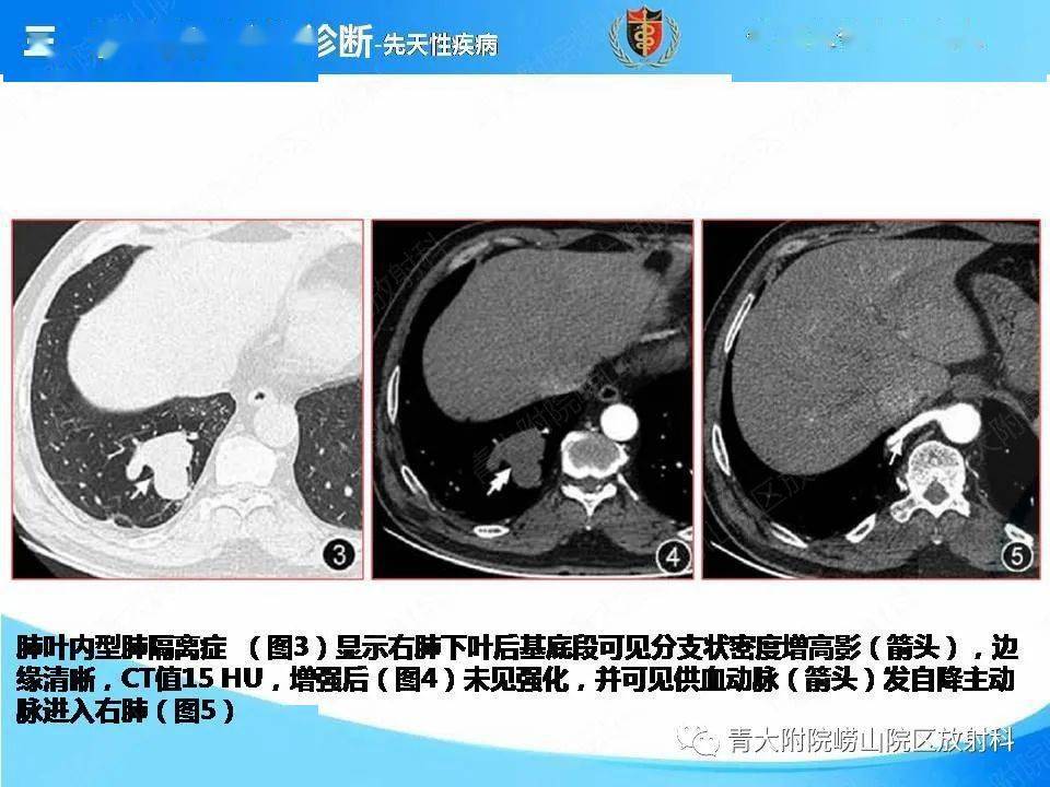 气管内粘液栓图片