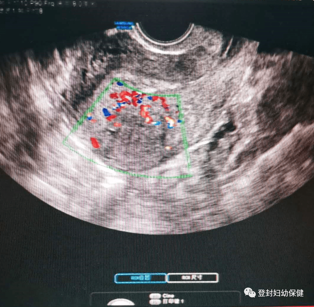 登封市妇幼保健院 | 合理地选择妇科超声检查方法很重要!
