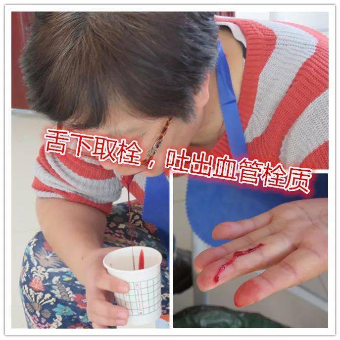 舌肿,口疮,喉闭,消渴,呕吐,腹泻,失语"这些个问题,刺血疗法——舌下取