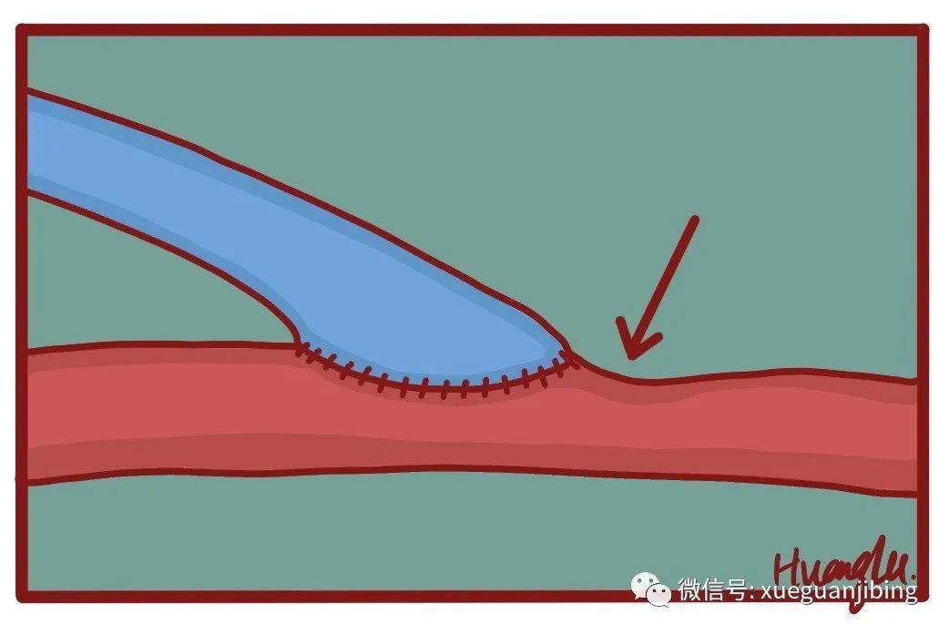 血管端侧吻合术图解图片