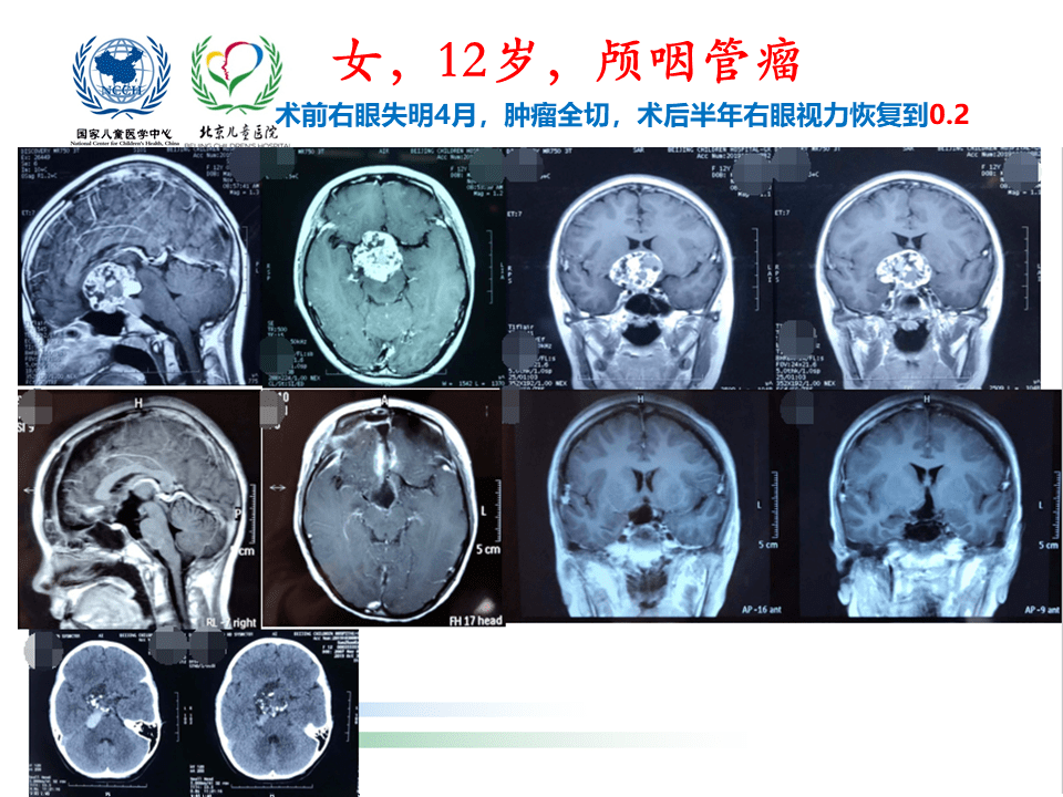 解剖课件 儿童鞍区肿瘤常见手术入路 北京儿童医院葛明