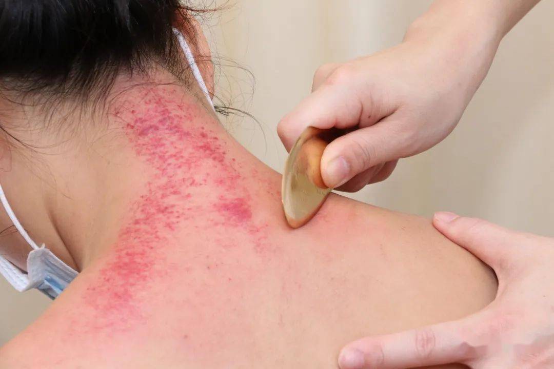 中医粉们:让您心心念念已久的中医护理门诊重新开诊了!_刮痧