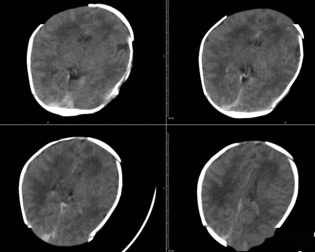 新生儿头颅ct正常图片图片