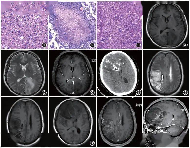 图1为少突胶质细胞瘤(whoⅡ级),瘤细胞密度中等,细胞核圆居中,胞质
