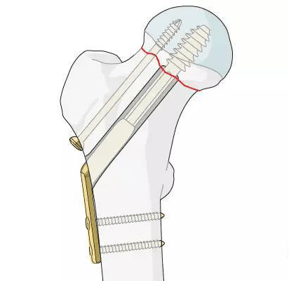 新视野|西青医院完成天津市首例骨科手术机器人辅助股骨